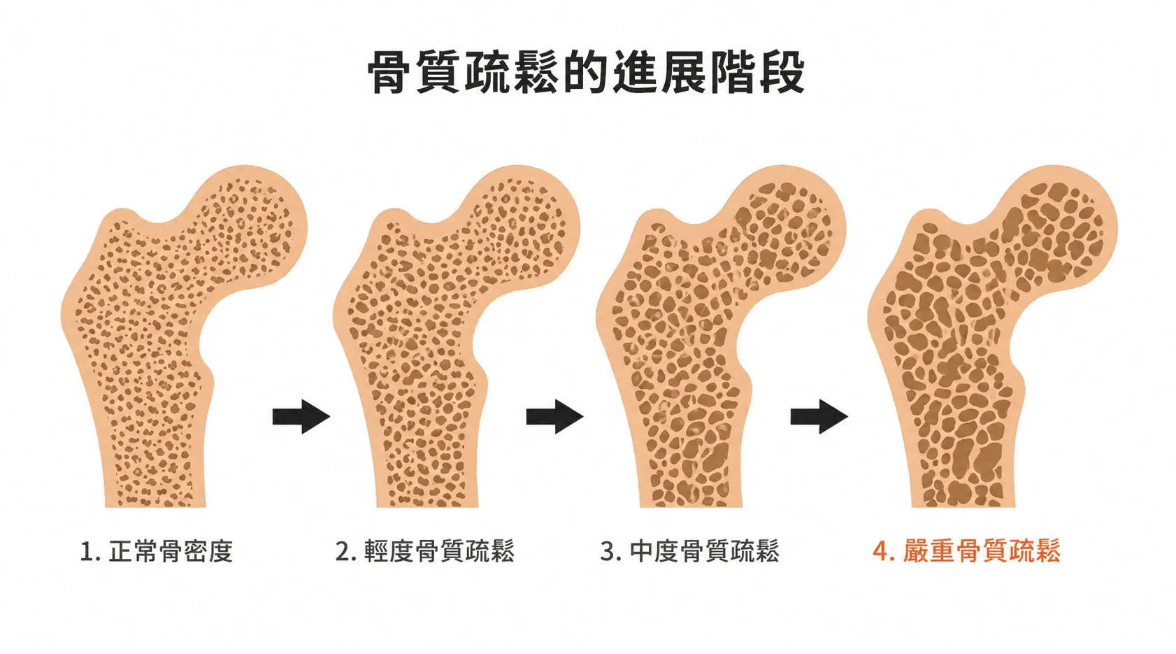 骨質疏鬆進展階段示意圖：由正常骨密度到嚴重骨質疏鬆，骨小樑逐漸變細斷裂